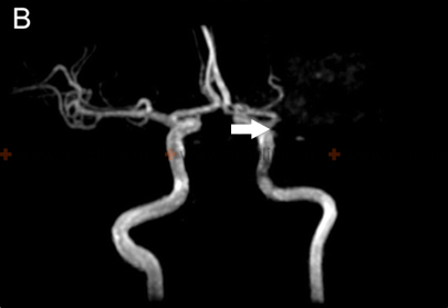 MRI angiography of cerebral vascular shows a left middle cerebral artery thrombosis (white arrow).